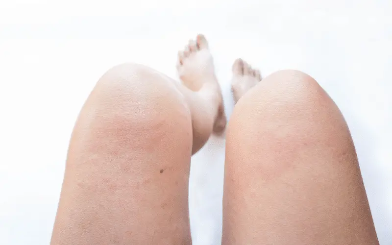 Skin Rash - The Visible Clue of Vasculitis