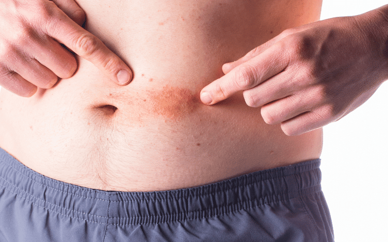 Skin Rashes The External Manifestation of Ulcerative Colitis