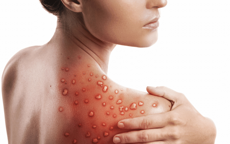 Skin Rashes and Lesions Dermatological Indicators of Severe Ulcerative Colitis