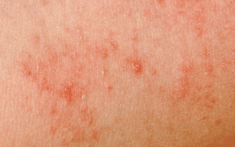 Skin Rashes and Lesions