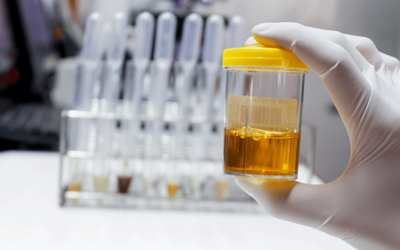 Sudden Decrease in Urine Output A Clear Warning Sign of AKI