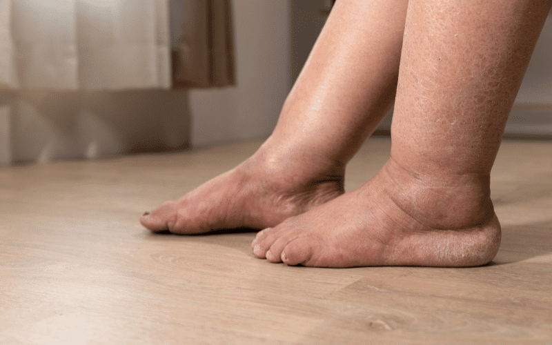 Swelling in the Hands, Feet, and Ankles