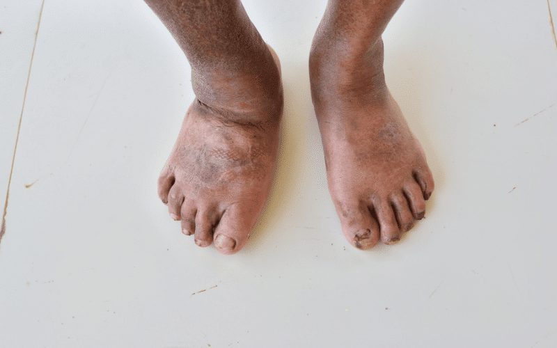 Swelling of the Legs and Ankles A Telltale Sign of Fluid Retention