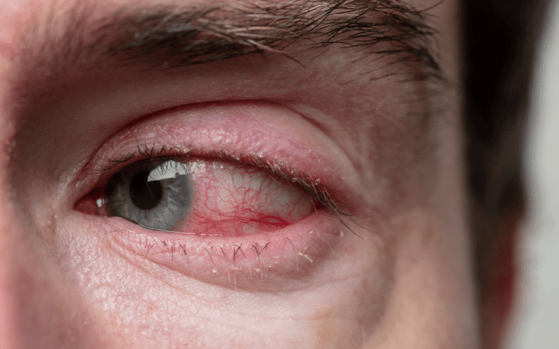 Swollen Eyelids- The Puffy Telltale of Conjunctivitis