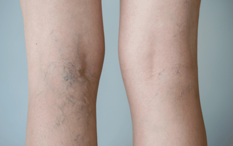 Varicose Veins