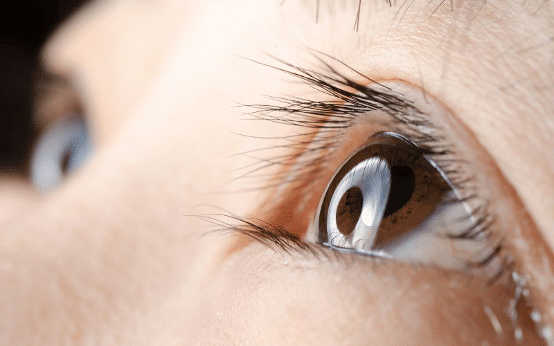 Watery Eyes An Unexpected Consequence of Blepharitis