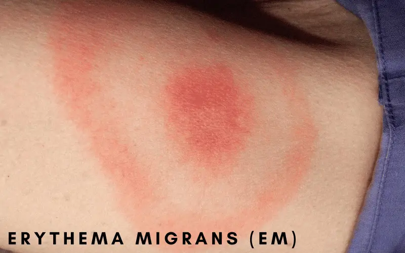 erythema migrans (EM)