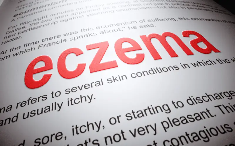 The Science Behind the 7 Different Types of Eczema How to Identify and Treat Each Variation