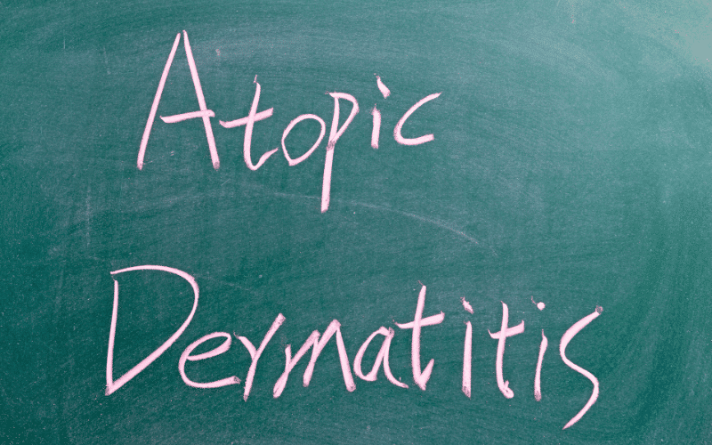 Unmasking Atopic Dermatitis The Top 10 Causes