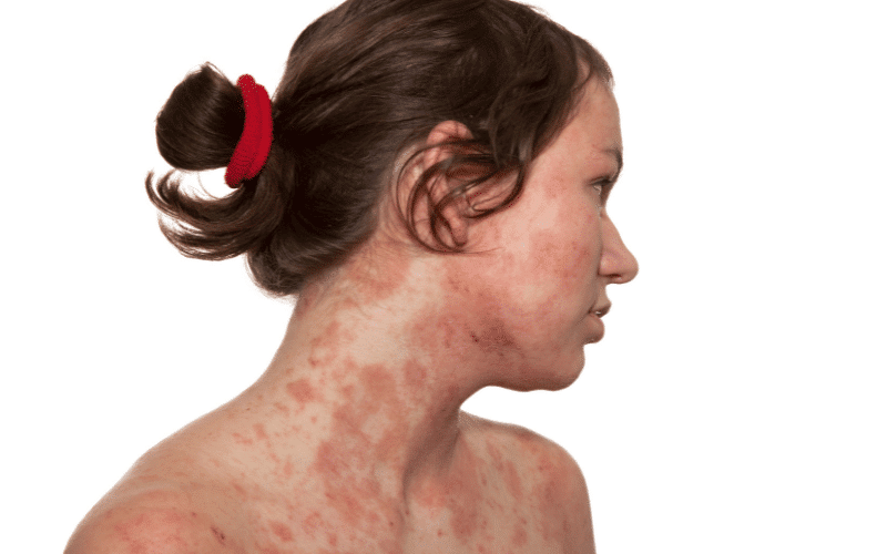 Atopic Dermatitis The Chronic Itch Cycle