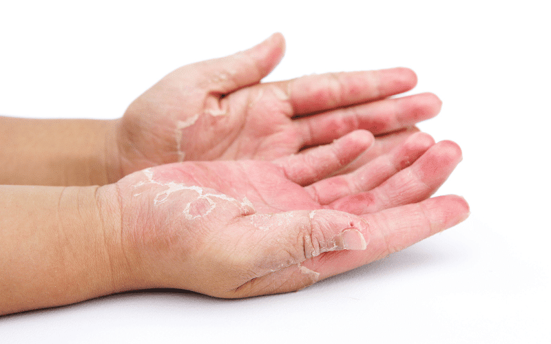 Contact Dermatitis Skin's Direct Protest