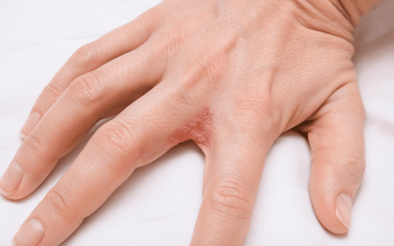 Dyshidrotic Eczema A Vesicular Eruption