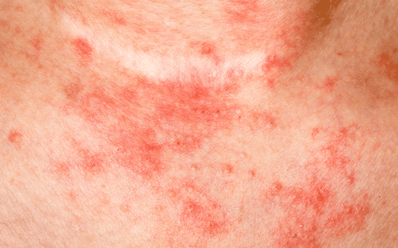 Eczema – An Itchy Inflammation