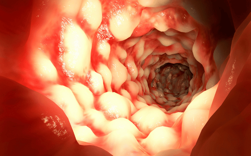 Endoscopic Appearance - The Bowel's Tale