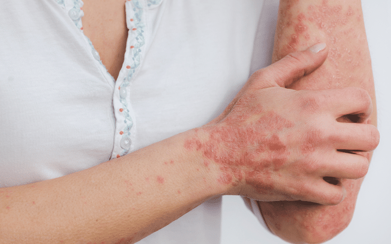 Psoriasis – The Persistent Plaques