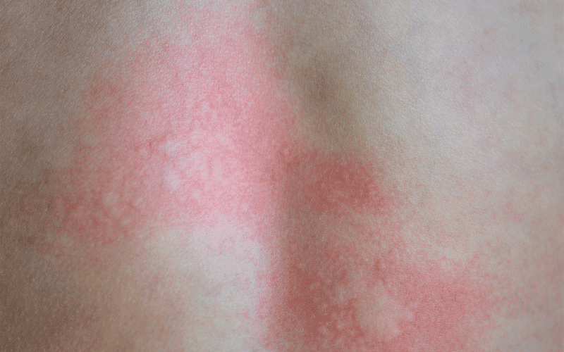 Skin Redness The Inflammatory Side of Neurodermatitis