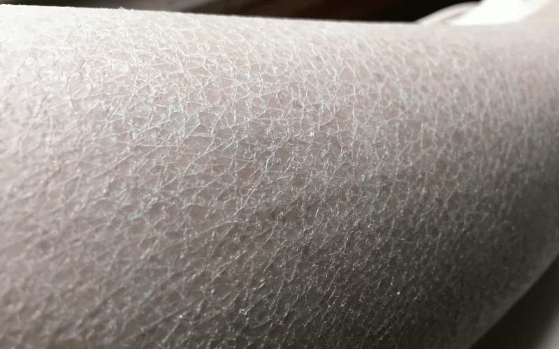 Dry, Scaly Skin The Deceptive Simplicity of Neurodermatitis