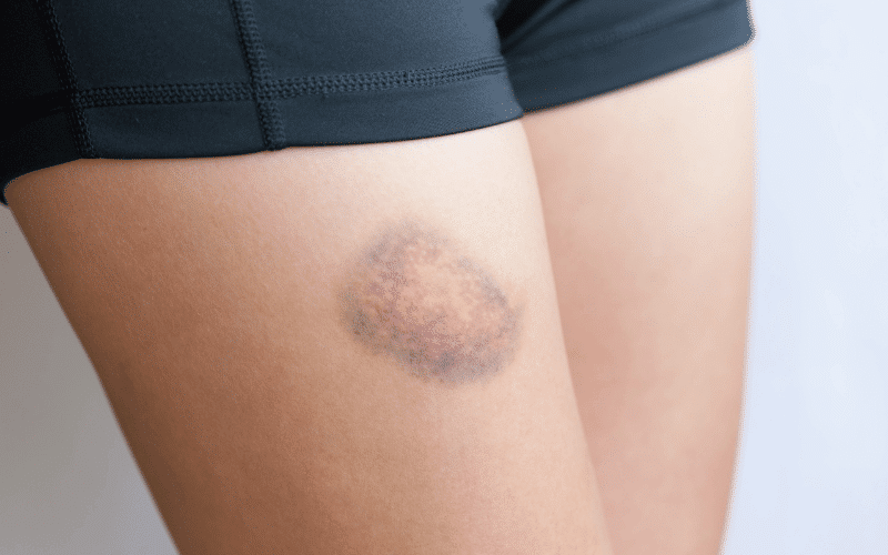 Easy Bruising or Bleeding A Subtle Sign of a Struggling Liver