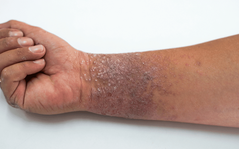 Stasis Dermatitis When Circulation Slows