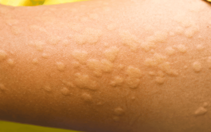 Hives – The Sudden Swellings