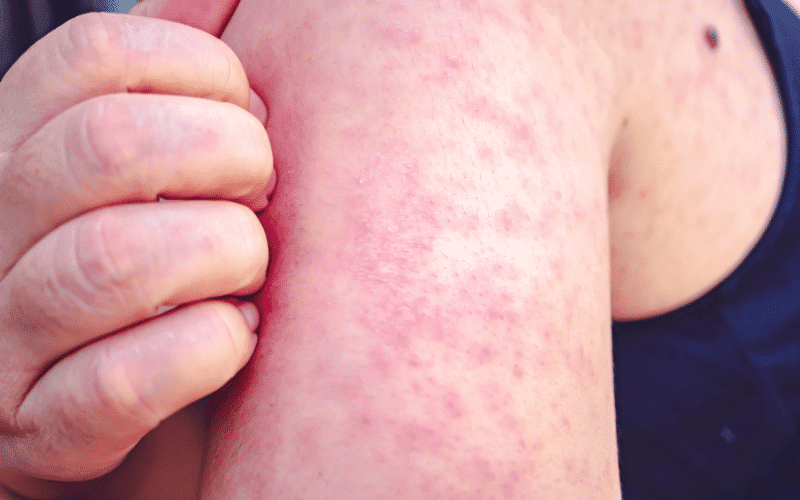 Itchy Skin An Irritating Indication of Liver Trouble