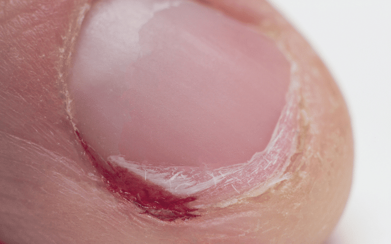 Brittle Nails and Hair Unwelcome Side Effects of Microcytic Anemia