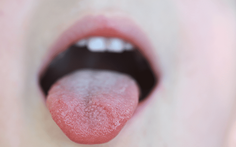 Swelling or Soreness of the Tongue An Unusual Sign of Microcytic Anemia