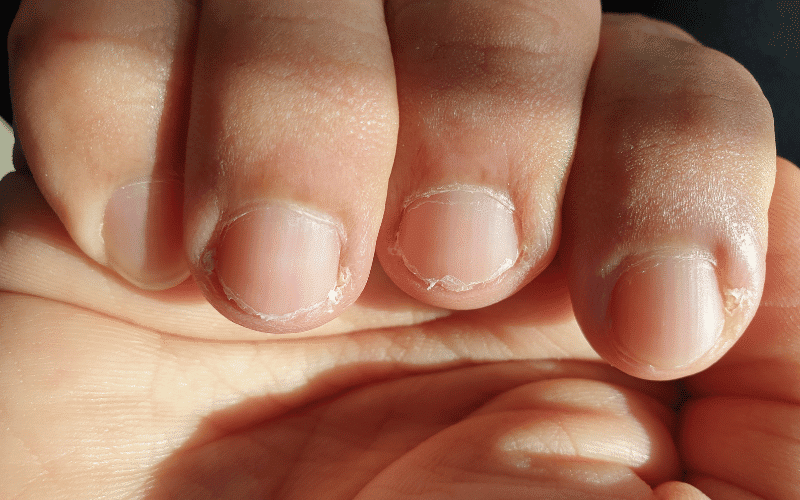 Brittle or Spoon-Shaped Nails Anemia's Impact on Your Fingernails