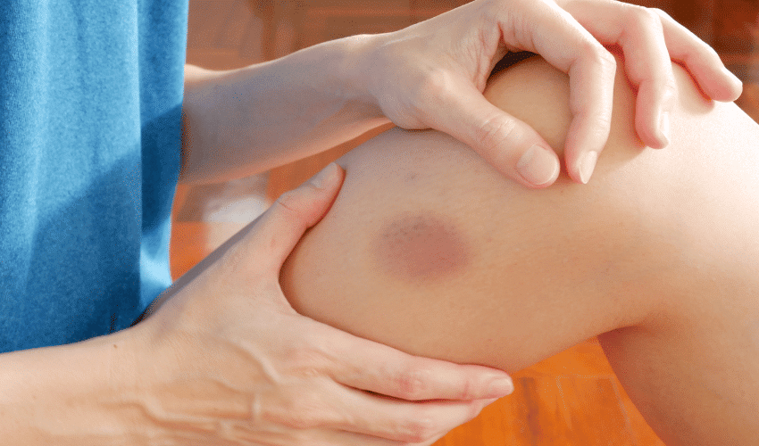 Sign of Liver Damage: Easy Bruising and Bleeding