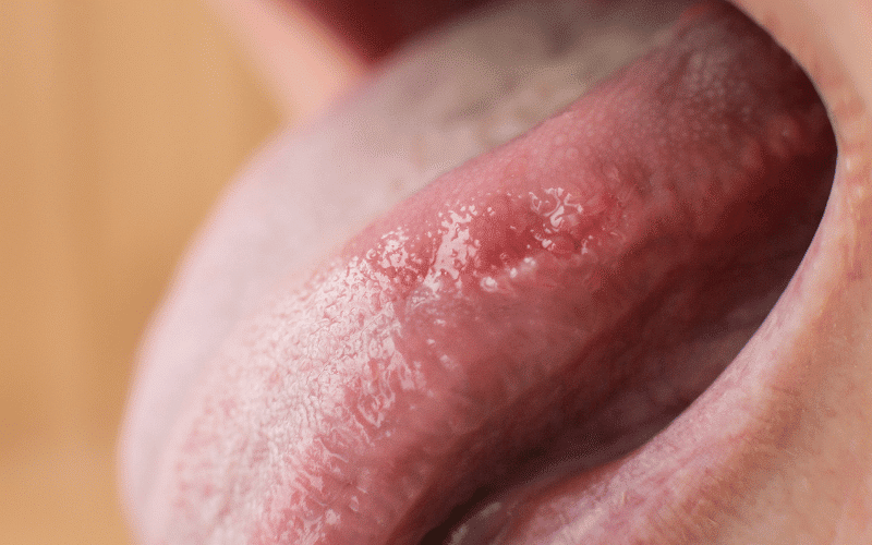 Swollen Tongue Anemia's Uncomfortable Oral Impact