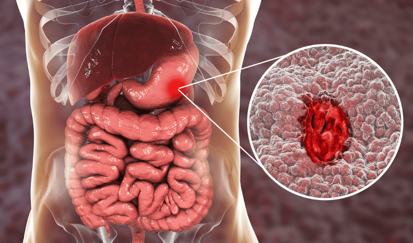 Cause of Anemia: Gastrointestinal Bleeding