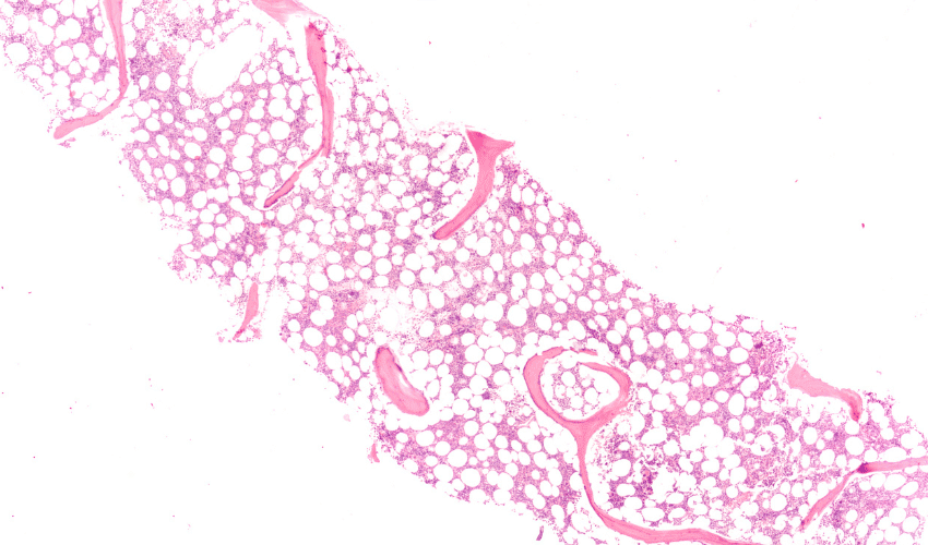 Cause of Anemia: Bone Marrow Disorders