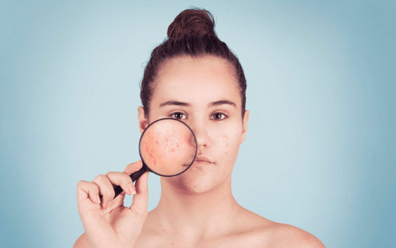 Acne A Common Skin Concern