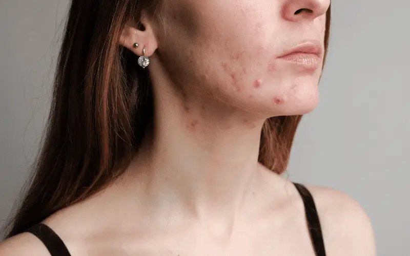 Acne More Than Just a Teenage Problem