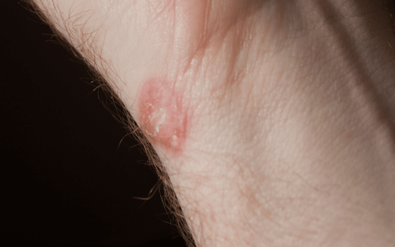 Ringworm (tinea Corporis): 13 Symptoms You Need To Know About In Humans