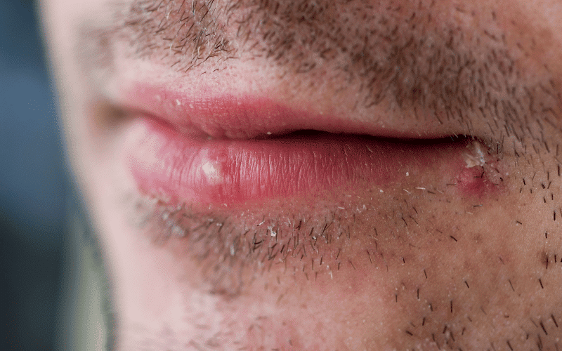 Cold Sores (Herpes Labialis) The Unwelcome Visitor