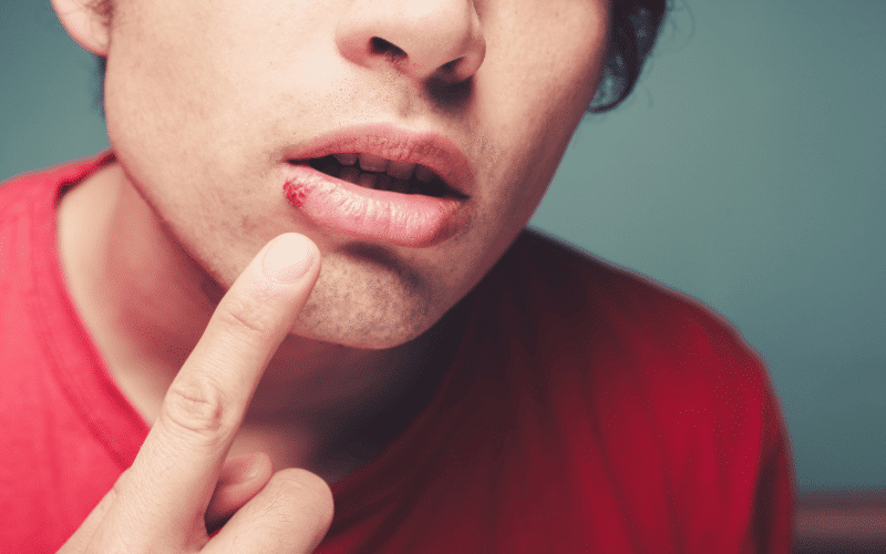 Cold Sores The Painful, Contagious Skin Blisters