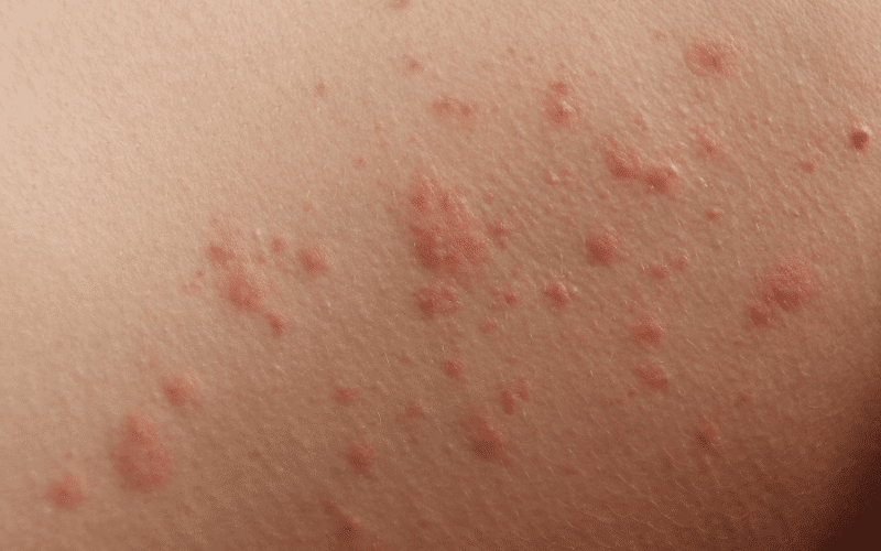 Contact Dermatitis A Reaction to External Irritants