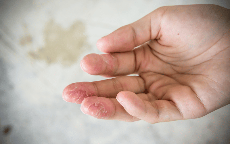 Contact Dermatitis When Skin Meets Irritant