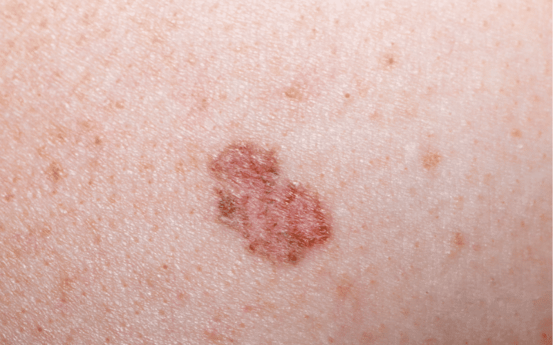 Darkened or Discolored Skin A Long-Term Effect