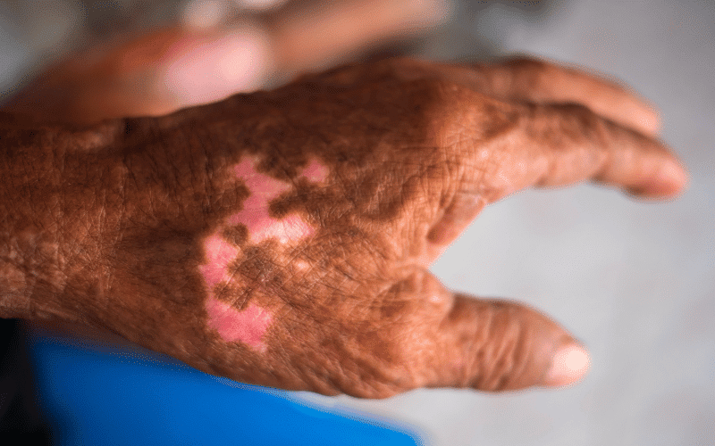 Darkening or Lightening of the Skin A Lasting Reminder of Contact Dermatitis