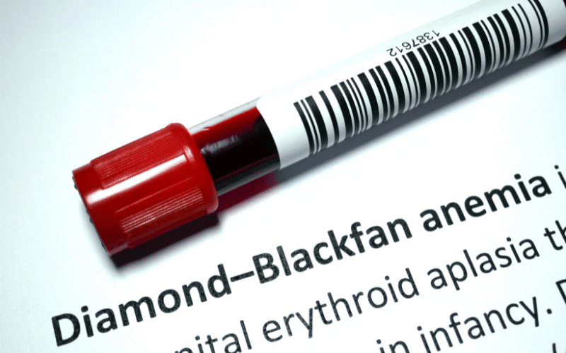 Diamond-Blackfan Anemia A Congenital Bone Marrow Failure Syndrome