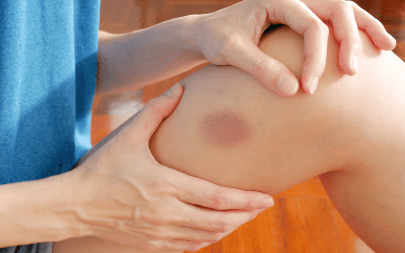 Easy Bruising and Bleeding A Sign of Impaired Clotting