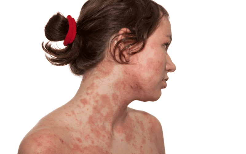 Eczema - A Chronic Inflammatory Skin Condition