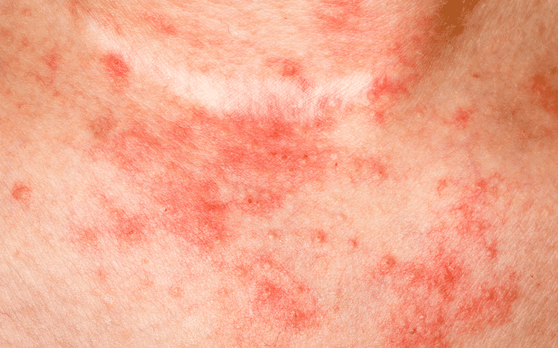 Eczema Itchy and Inflamed Skin