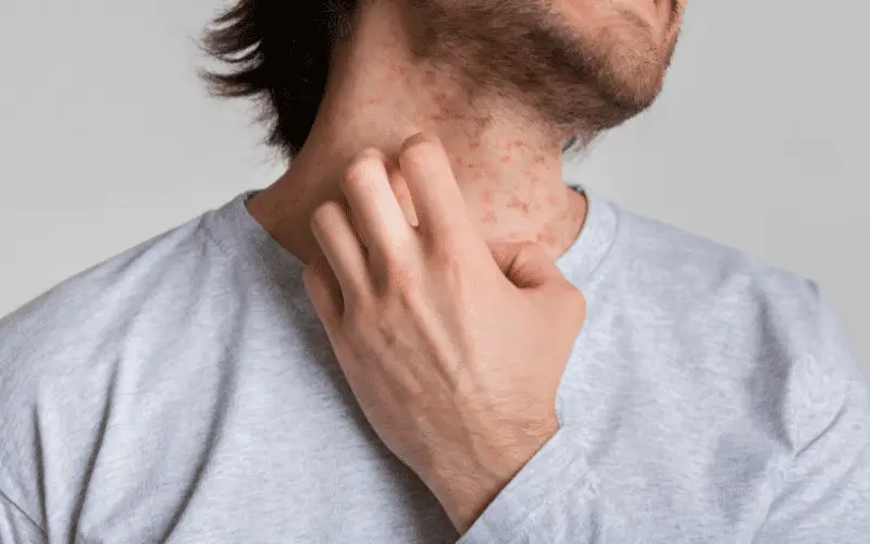 Eczema The Itchy, Inflammatory Skin Condition