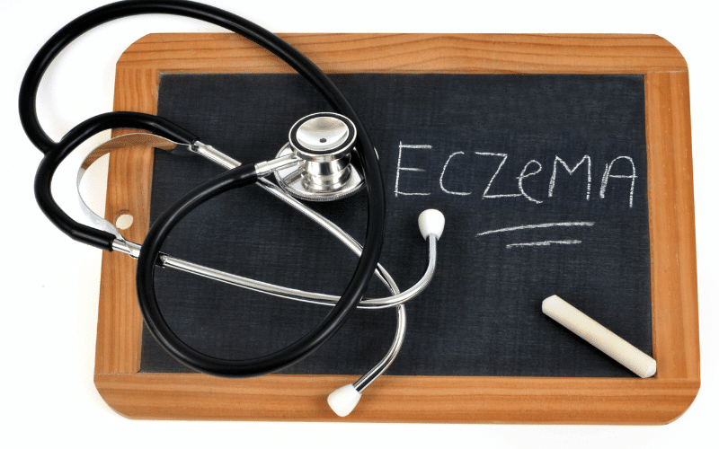 Eczema The Persistent Itch