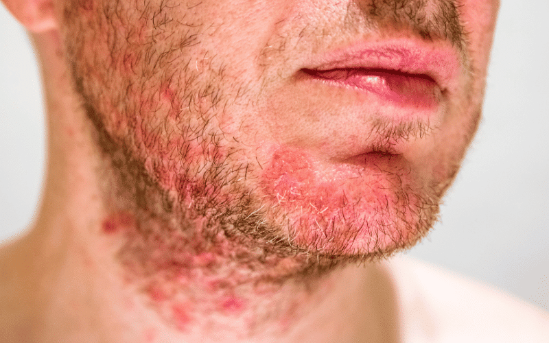 Frequently Asked Questions About Seborrheic Dermatitis