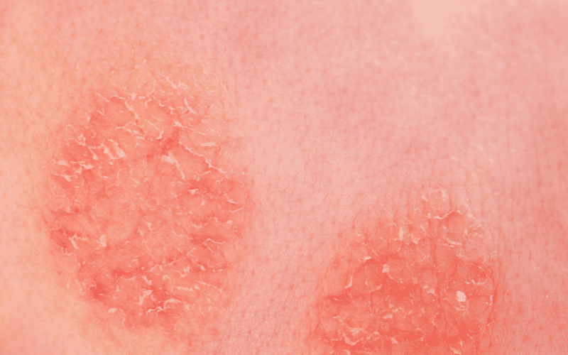 Frequently Asked Questions About Severe Atopic Dermatitis