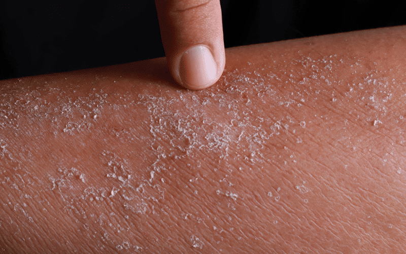 Frequently Asked Questions about Atopic Dermatitis Symptoms